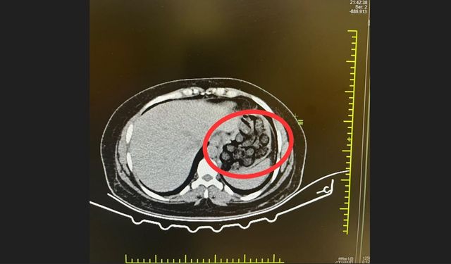 Mide Ve Bağırsaklarından 70 Parça Metamfemin Çıktı